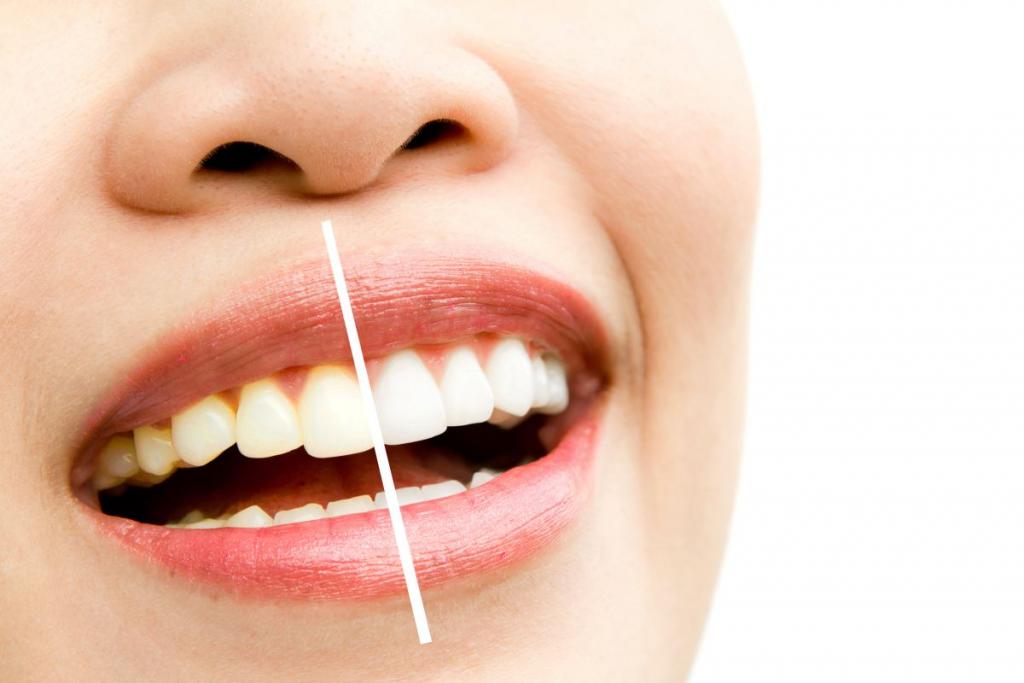 whitening - bleaching treatment ,woman teeth and smile, before a