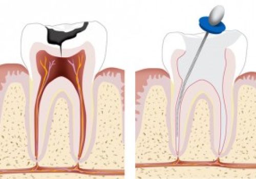 Endodoncia Imagen Endodoncia