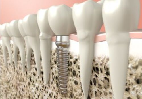 Implantología y regeneración ósea Imagen Implantología y regeneración ósea