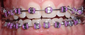 Brackets tip-edge